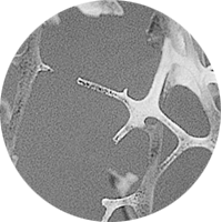 Bilde av osteoporotisk bein